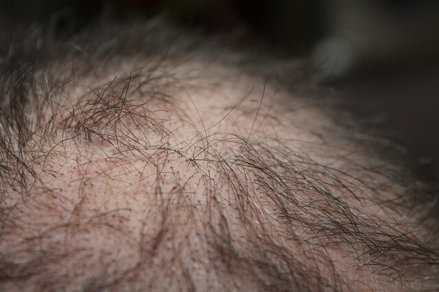 symptoms-of-vitamin-and-mineral-deficiency-hair-loss